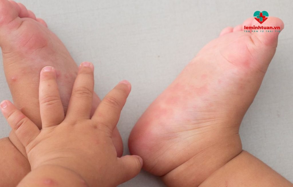Trẻ bị sốt lòng bàn tay chân nóng nguyên nhân và giải pháp từ chuyên gia