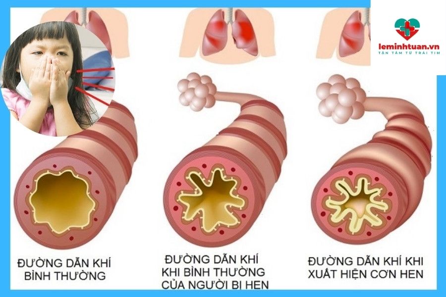 Bé bị ho phải làm sao? Cách trị ho đơn giản tại nhà mẹ nên biết.