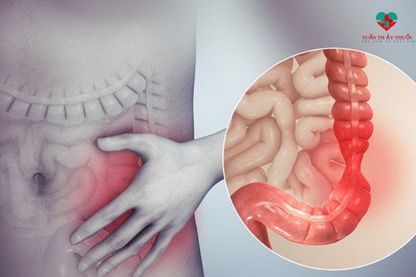 Nguyên nhân đi ngoài không thành khuôn? Cách giúp đi ngoài bình thường