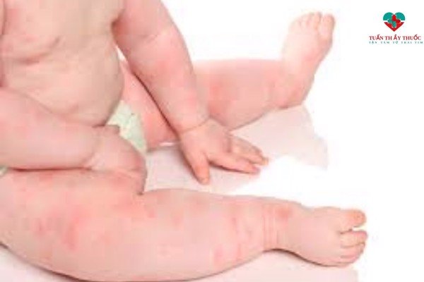 Trẻ sơ sinh đi ngoài có hạt đen nguyên nhân dấu hiệu và cách xử lý